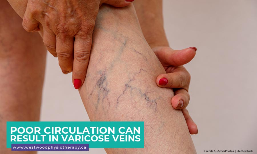 Poor circulation can result in varicose veins