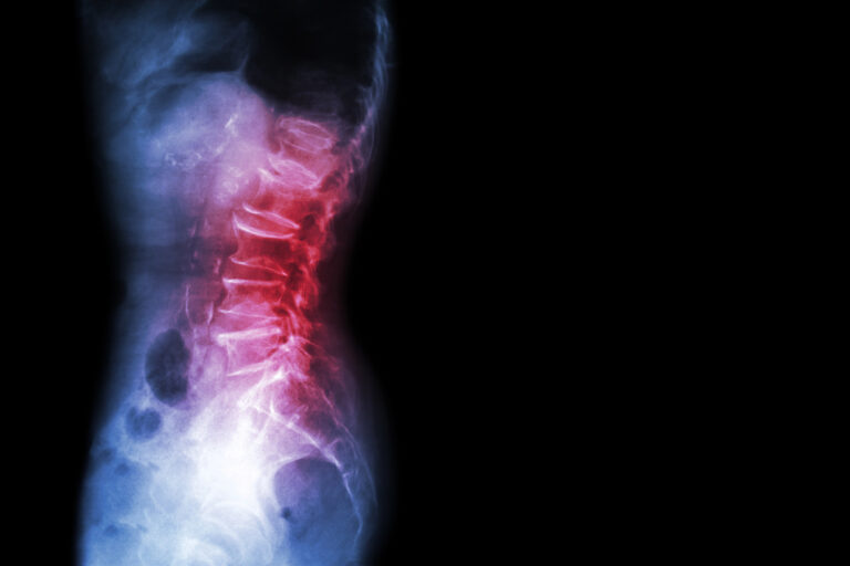 Spondylolisthesis Core Training: Safe Strategies for Spinal Stability