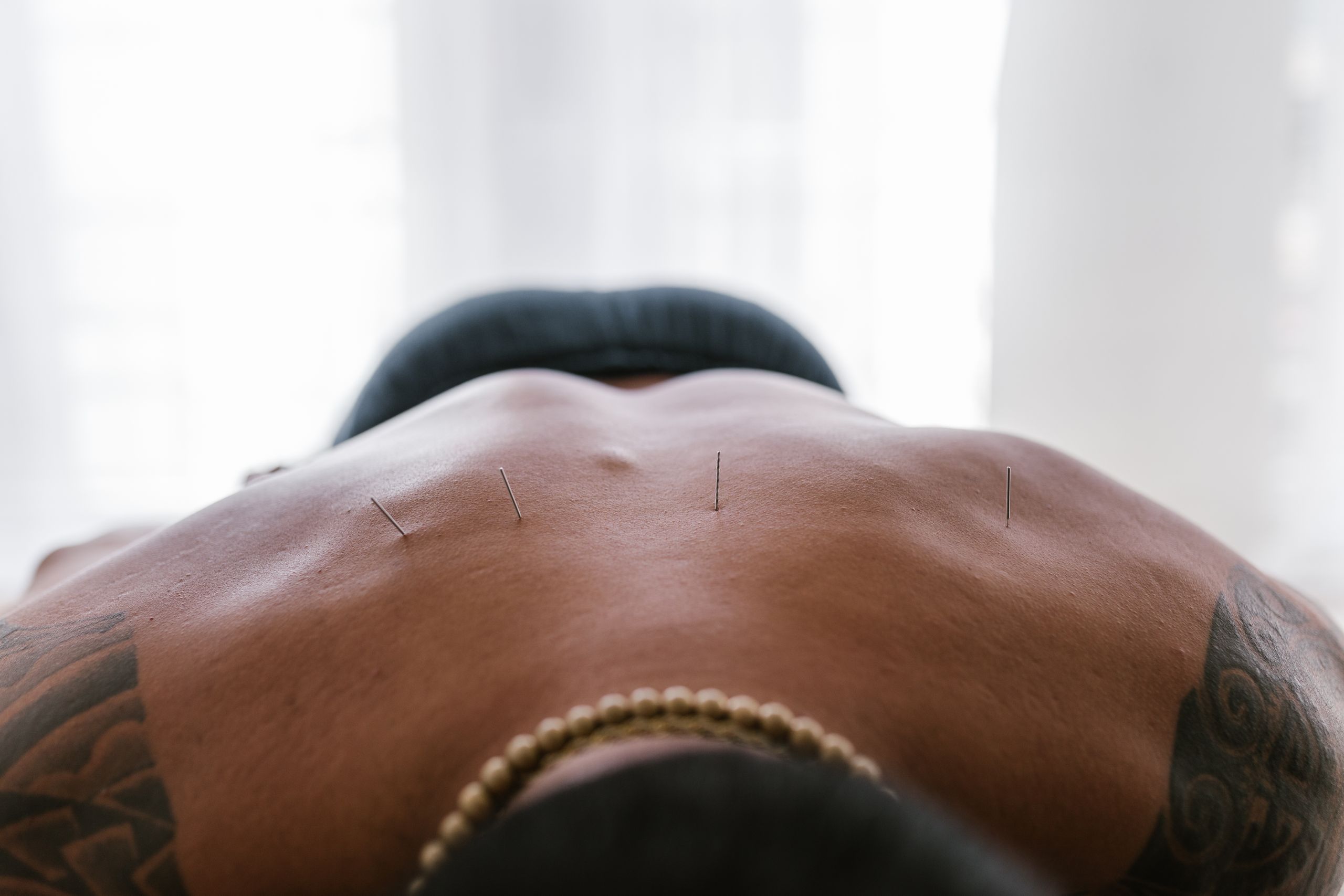 Dry needling treatment in Guelph
