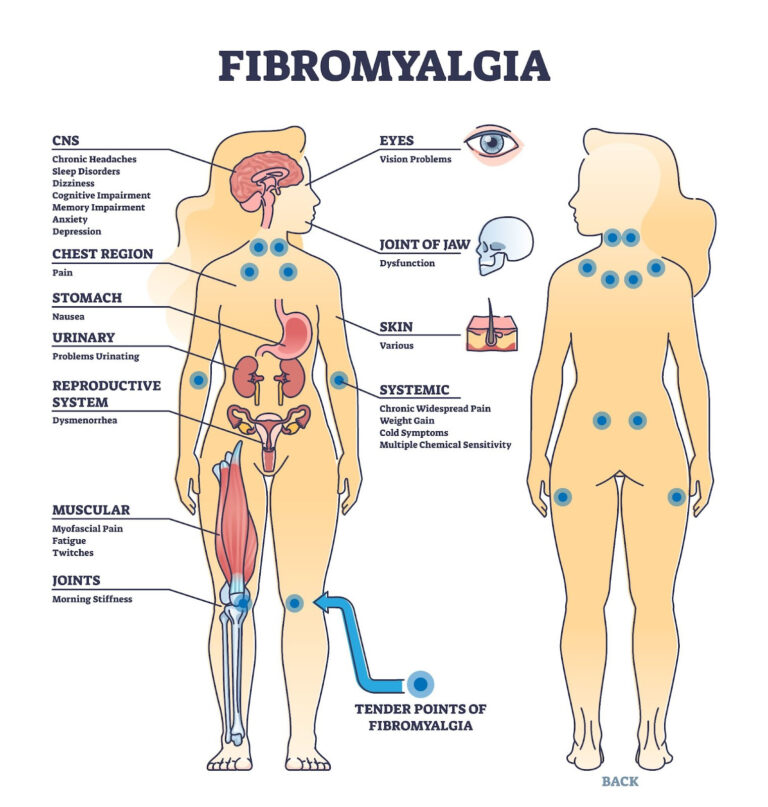 Fibromyalgia Management in Guelph: Understanding Nervous System Regulation & Physiotherapy